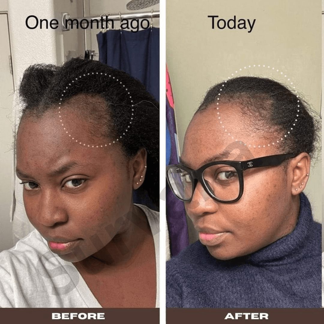 The Ordinary Multi-Peptide Hair Serum 60mL With Free Derma Roller đĨ